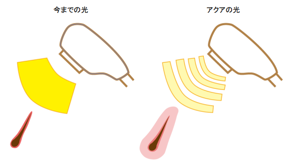 THR脱毛機「AQUA」